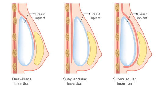 Breast-Augmentation-using-implants