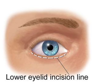 Face-Neck-lower-eyelid-incision-line