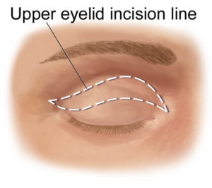 Face-Neck-upper-eyelid-incision-line