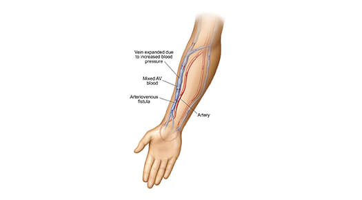 AV-fistula - Dr Abizer Kapadia