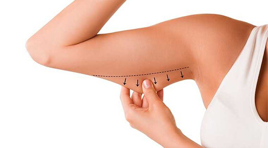 Body Lift- Arm Brachioplasty - Dr Abizer Kapadia