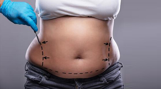 Body Lifts- tummy tuck - Dr Abizer Kapadia