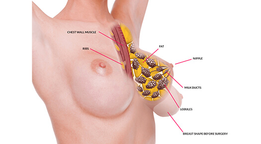 Breast Lift - Dr Abizer Kapadia