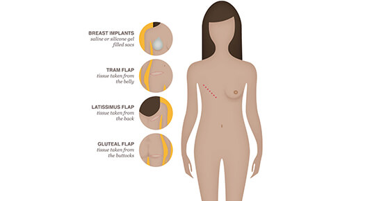 Breast Reconstruction - Dr Abizer Kapadia