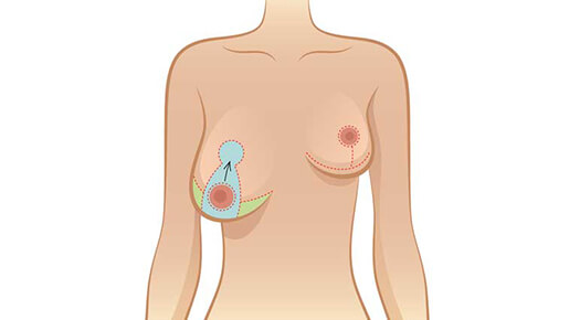 Breast Reduction - Dr Abizer Kapadia