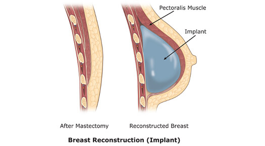 Breast Reconstruction Implant- Dr Abizer Kapadia
