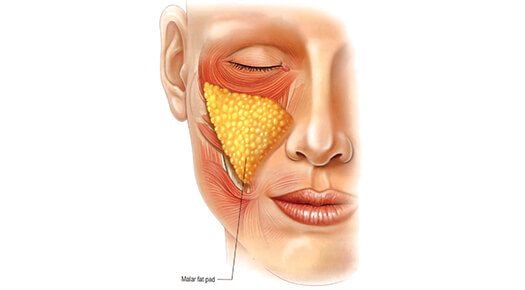 Face & Neck - Cheek Augmentation - Dr Abizer Kapadia