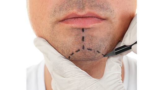 Face & Neck - Chin Surgery - Dr Abizer Kapadia