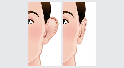 Face & Neck - Ear Surgery- Otoplasty - Dr Abizer Kapadia