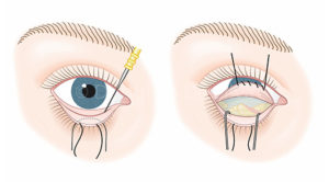 Face & Neck-Eyelid Surgery-lower eyelid blepharoplasty - Dr Abizer Kapadia