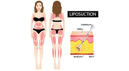 Fat Reduction - Surgical Fat Reduction _Liposuction - Dr Abizer Kapadia