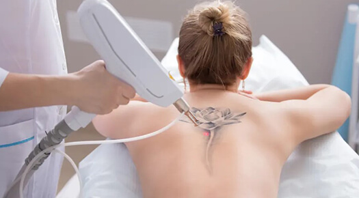 Tattoo removal - Dr Abizer Kapadia