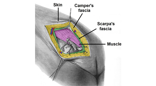 Trauma- Wound Coverage and Scar Revision - Dr Abizer Kapadia