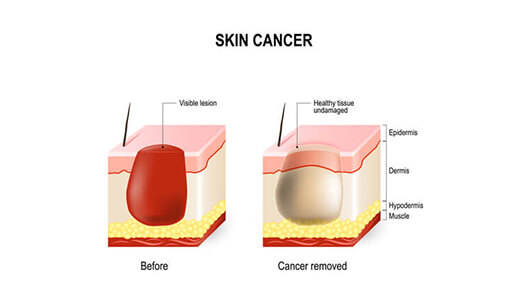 skin cancer removal procedure - Dr Abizer Kapadia