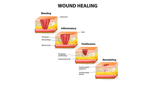 wound-healing-graphic - Dr Abizer Kapadia
