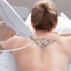 tattoo_removal_service1