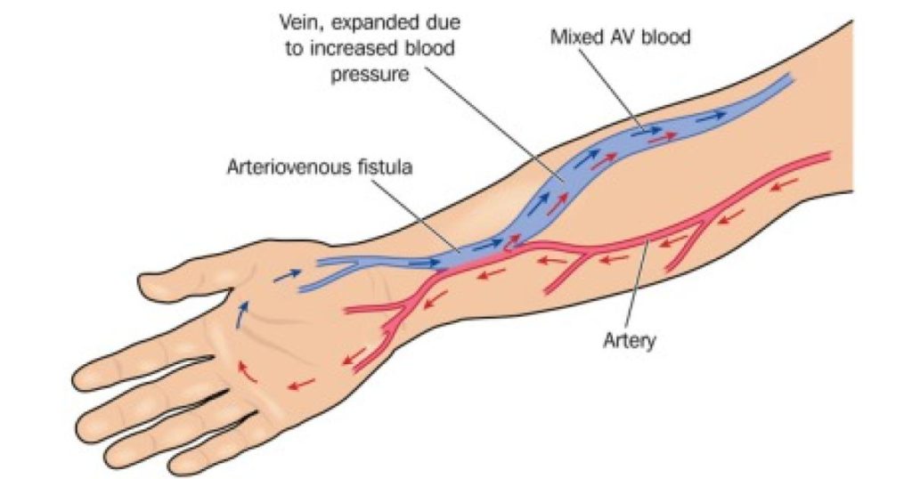 A-V fistula for Renal Dialysis