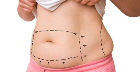 High-Definition Liposuction