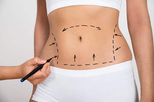 non-surgical liposuction